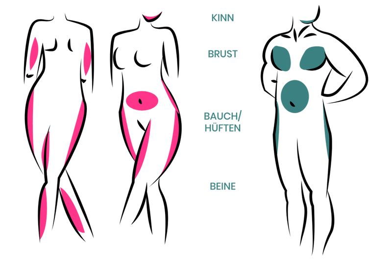 Fettabsaugung – Endstation für unliebsame Fettdepots